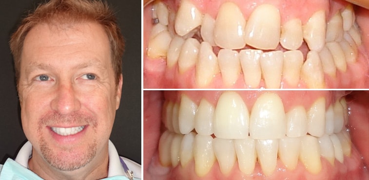 Invisalign case performed by Dr. Hinkle min