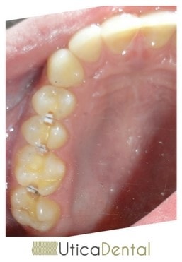 Patient with significant tooth decay between teeth