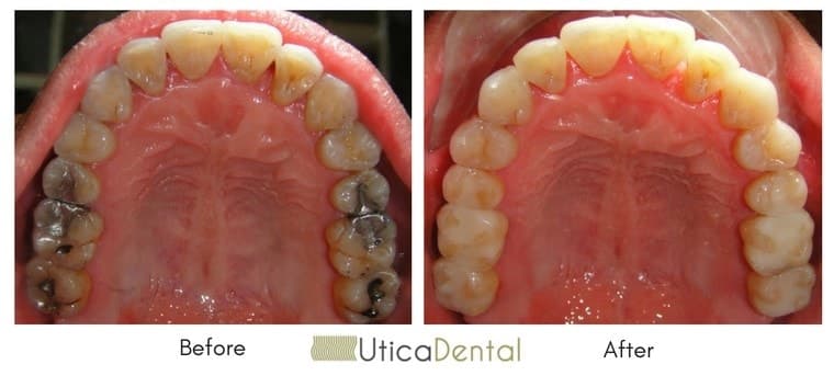 Before photo of patient with silver amalgam fillings and after with composite resin fillings
