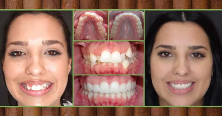  Invisalign® before and after photos of our patient, Sydney's who was told she was not a candidate for Invisalign