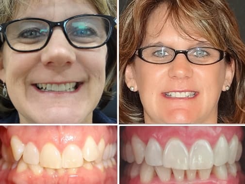 real invisalign patients with real results