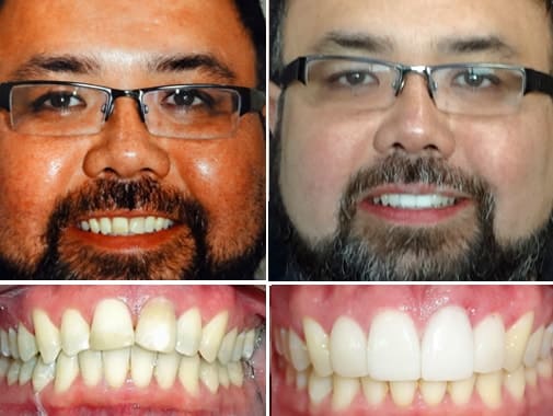 real invisalign patients with real results