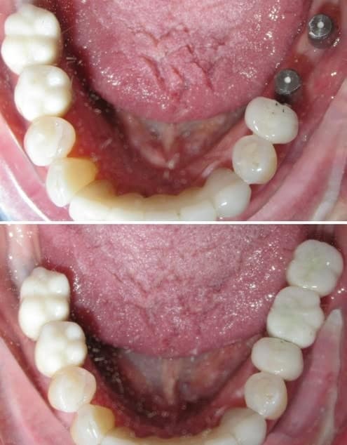 utica dental tulsa ok dental implants gallery