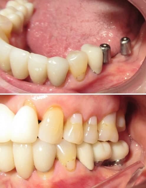 utica dental tulsa ok dental implants gallery