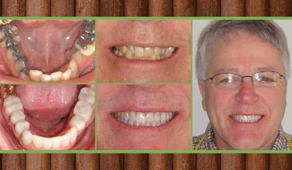 utica dental tulsa ok smile gallery smile with Invisalign
