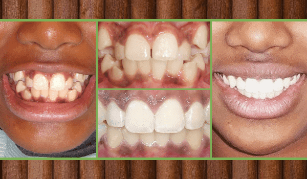 utica dental tulsa ok smile gallery smile with Invisalign
