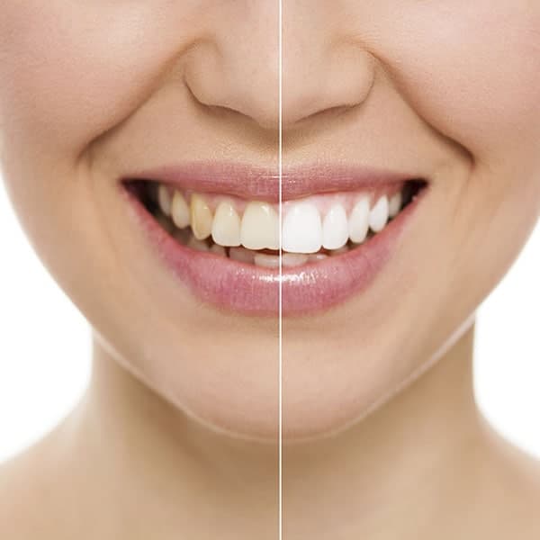 utica dental tulsa ok teeth whitening why