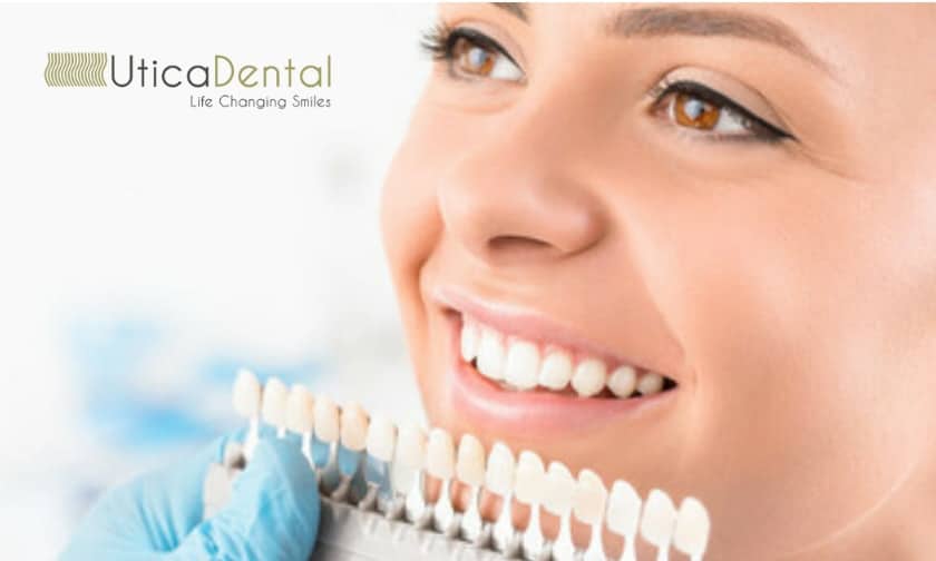 Advantages Of Dental Veneers