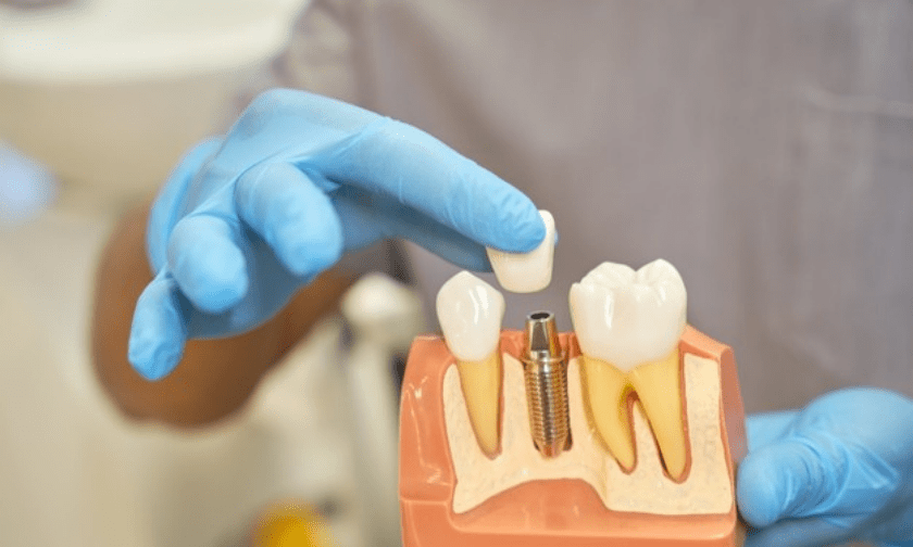 Why Are Dental Implants Becoming Increasingly Popular?