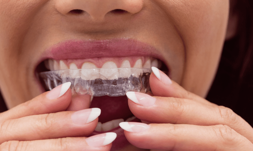 Ask Your Invisalign Dentist These Questions.