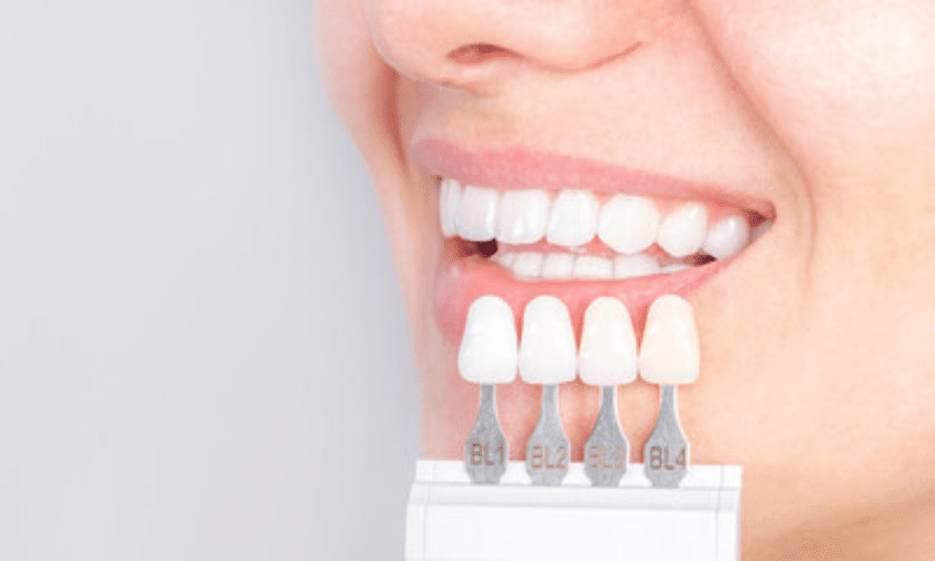 Know about dental veneers in Tulsa.