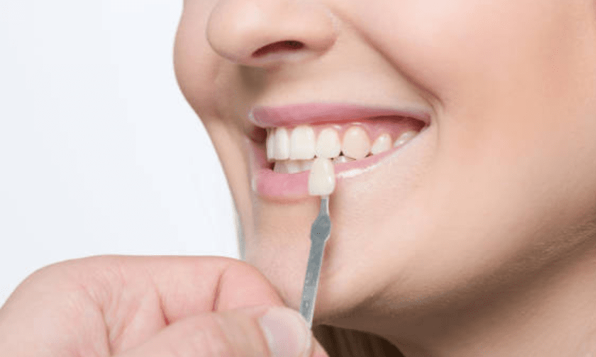 Dental Veneers: Porcelain Veneer Uses and Procedure