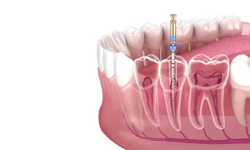 Illustration of root canal