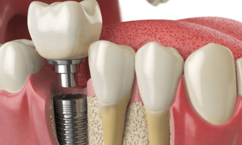 Dental Implants | Implant Types, Treatment, and Recovery