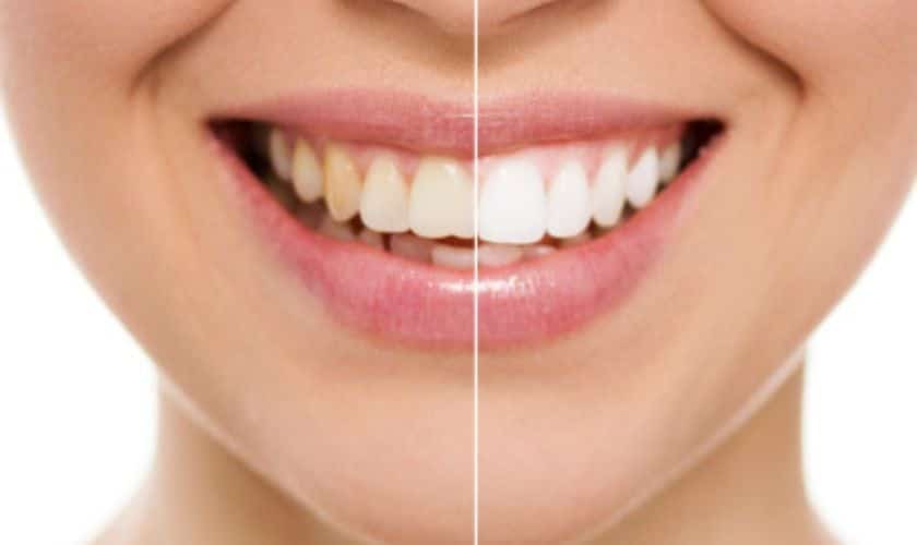 A Complete Guide To Teeth Whitening Treatment