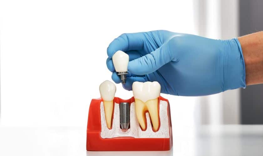 Dental Implant Complications: Identifying Higher Risk Factors and Ensuring Successful Outcomes
