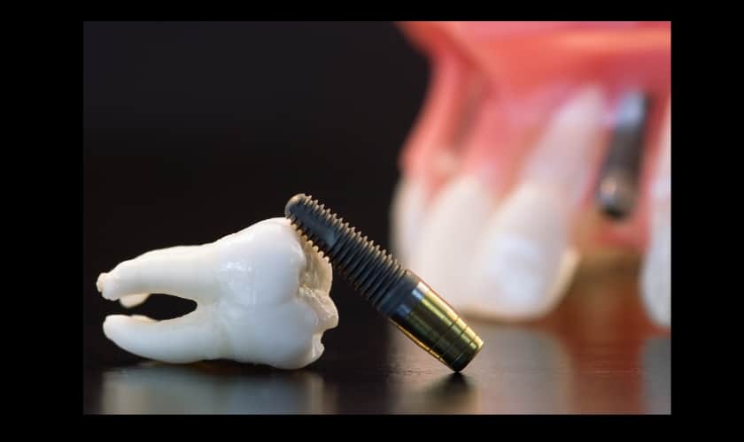Close up of dental implant model