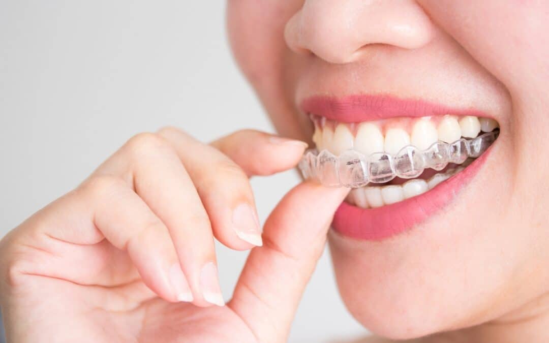 Hands placing clear aligner on teeth