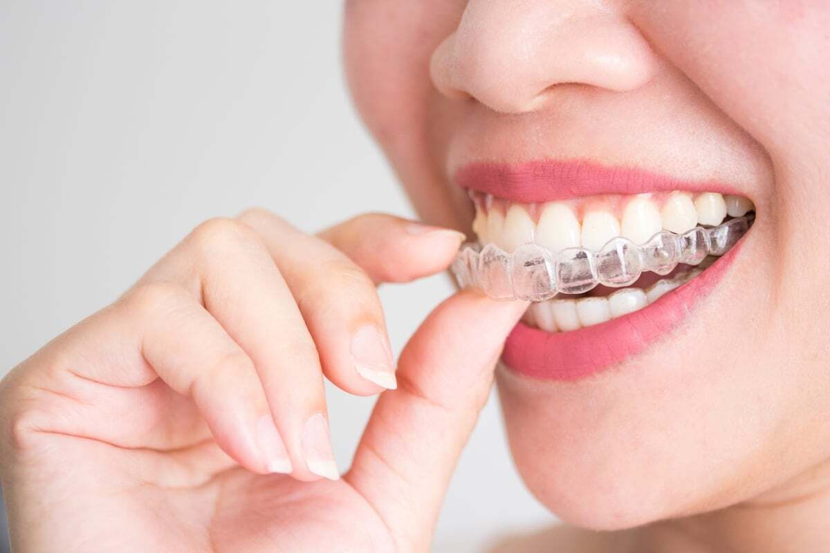Comprehensive Guide to Cleaning Your Invisalign Aligners