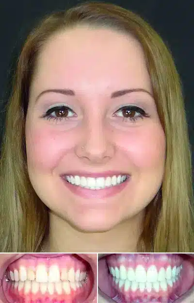 utica-dental-tulsa-ok-lumineers-example patient's before after