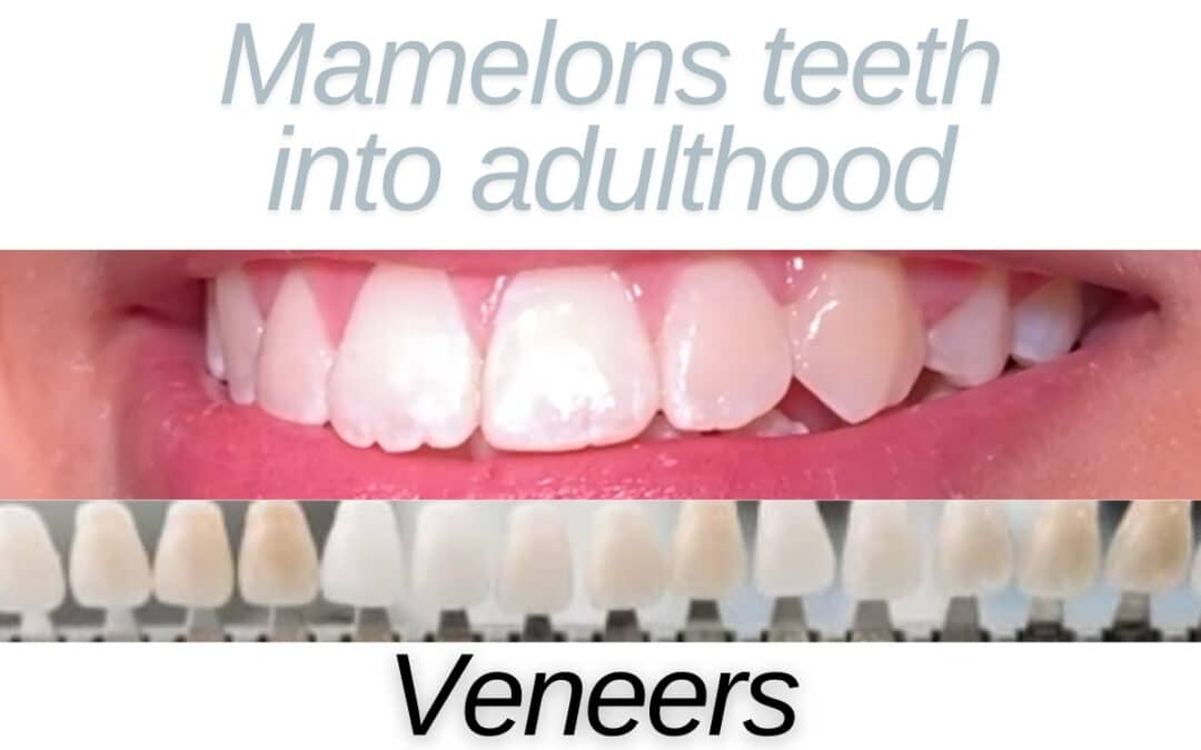 Close up of teeth with mamelons text graphic