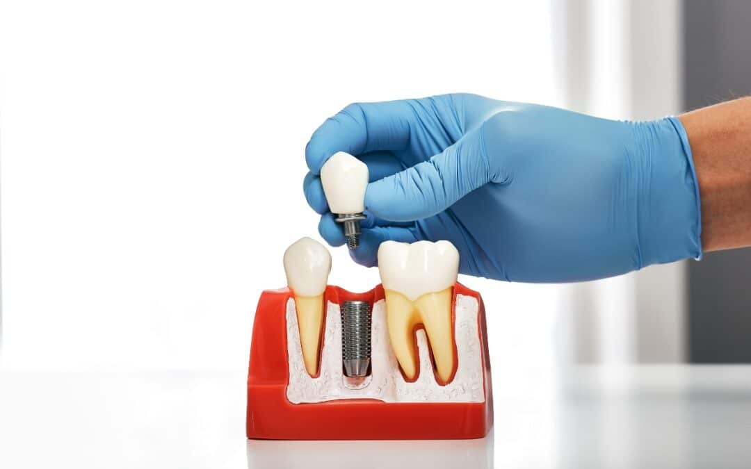 Gloved hand holding dental implant model