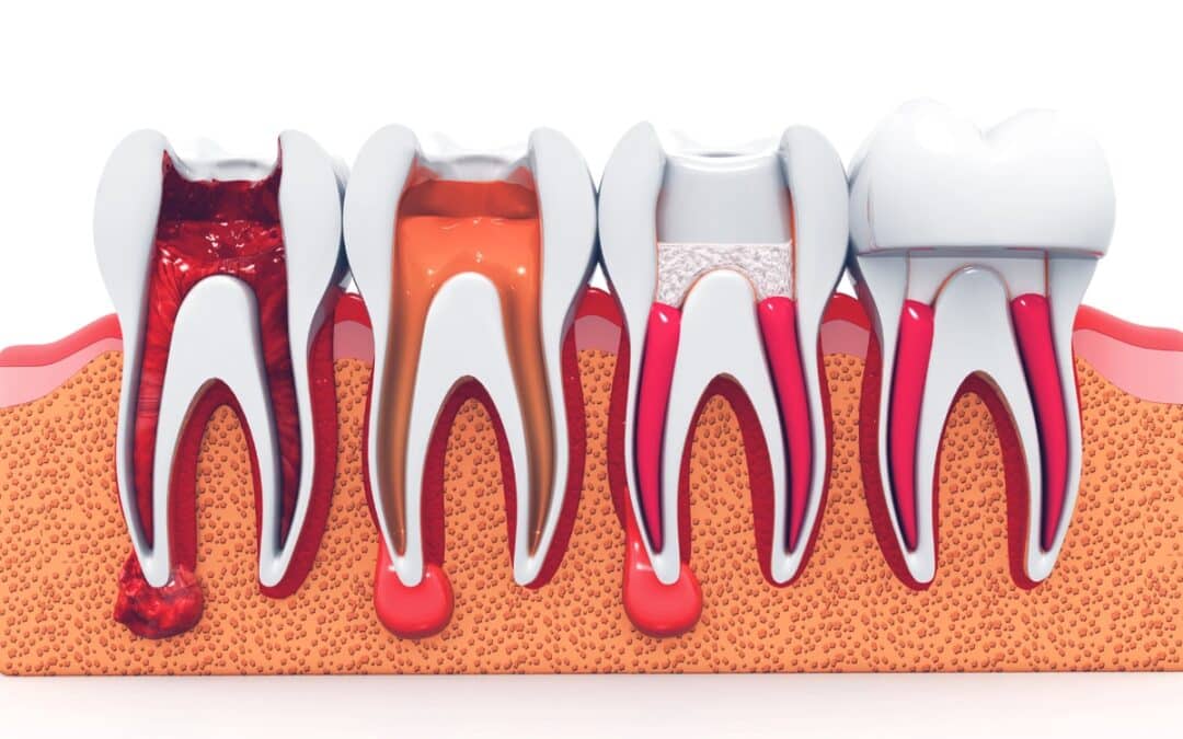 Illustration of root canal