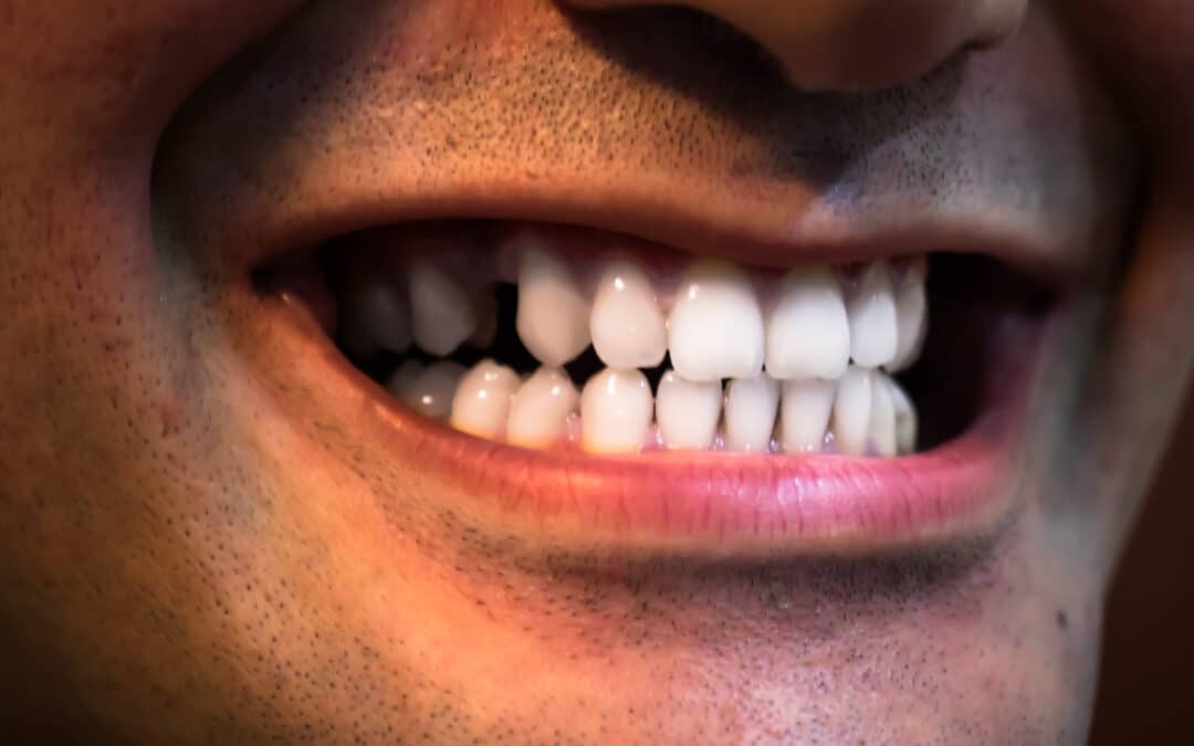 What Happens If You Don’t Replace a Missing Tooth?