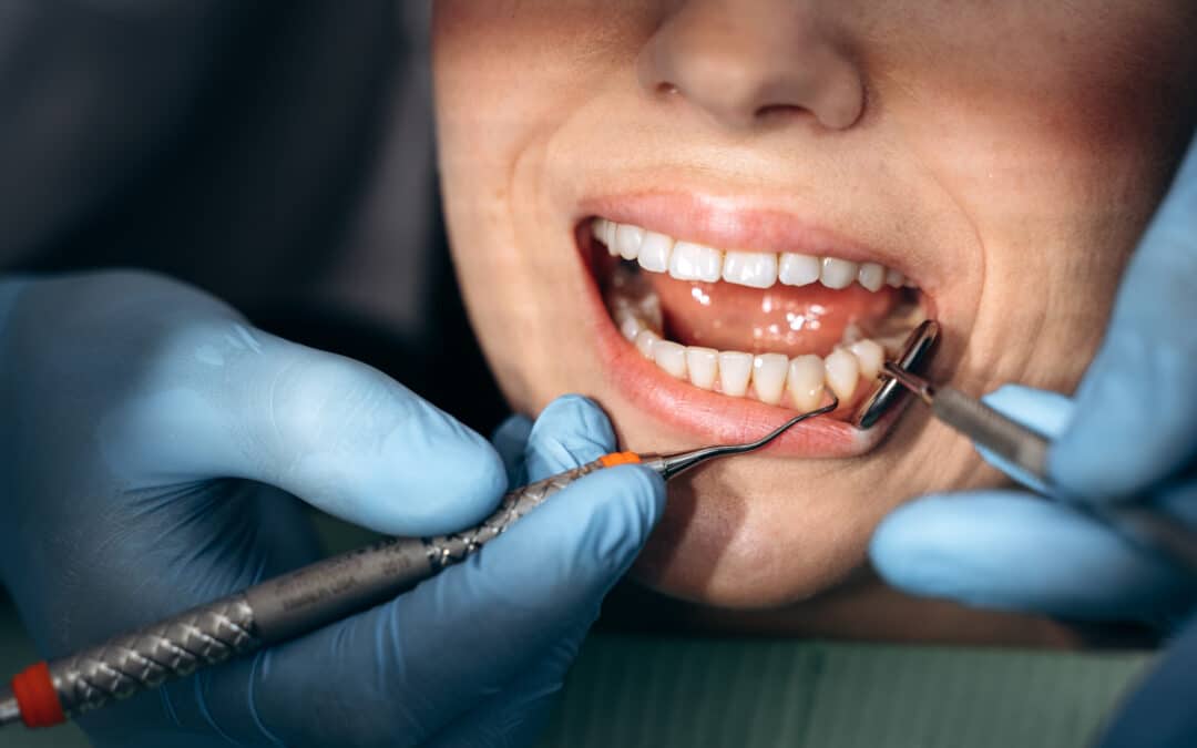 Do You Really Need Regular Dental Cleaning?