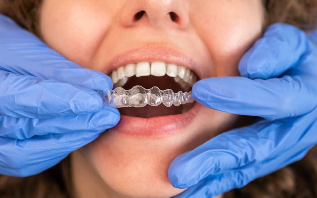 What Nobody Tells You Before Starting Invisalign